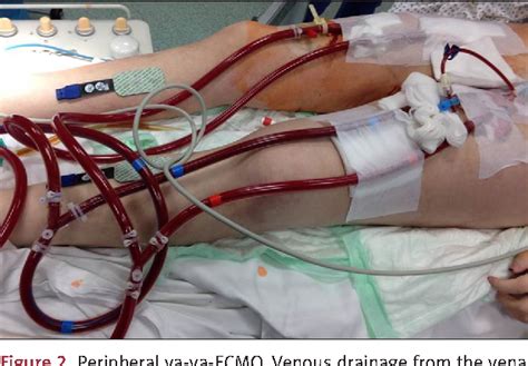 Pdf Double Peripheral Venous And Arterial Cannulation For