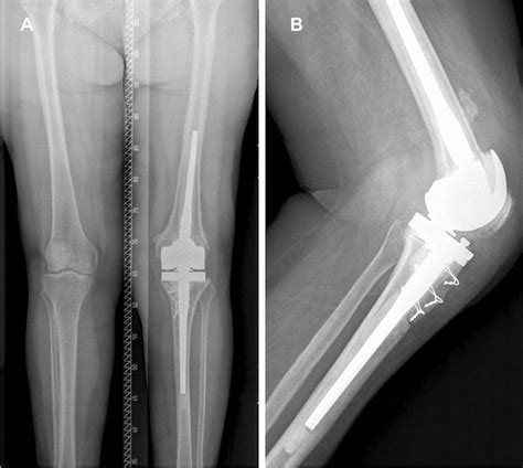 A Anteroposterior And B Lateral Post Operative Radiography Showing An Download Scientific