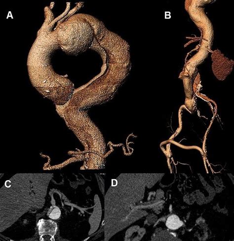 Pre Operative Images Of The Aorta A D Ct Reconstruction