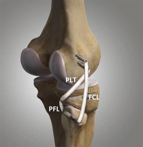 An All Arthroscopic Technique For Complex Posterolateral Corner