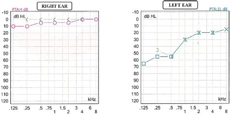 Low Frequency Sensorineural Hearing Loss In Left Ear Download Scientific Diagram