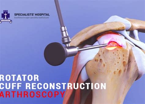 Arthroscopic Bankart Repair For Shoulder Dislocation Specialists