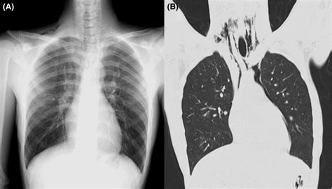 A Chest Xray Showing Emphysema Above The Right Clavicle And In The