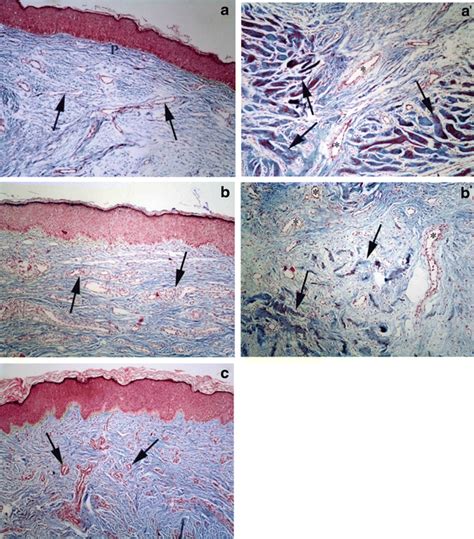 Photomicrographs Of Skin Section Obtained From Keloid Patient Number 15 Download Scientific