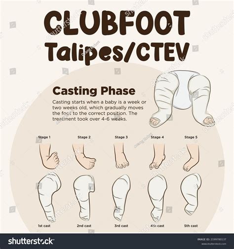 Line Art Vector Clubfoot Ponseti Method Stock Vector Royalty Free