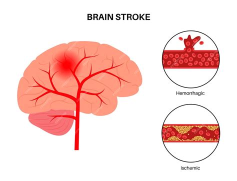 Premium Vector Brain Stroke Ishemic And Hemorrhagic