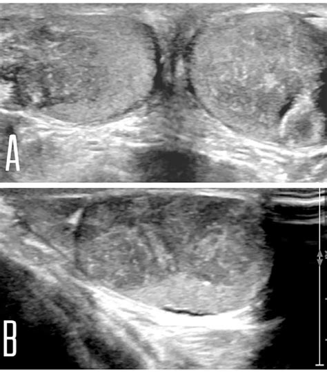 Testicular Adrenal Rest Tumor In A Pediatric Patient With Congenital