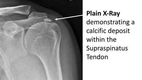 Calcifying Tendonitis And Radiological Calcification Type Resorptive Porn Sex Picture