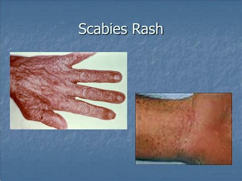 Ppt Scabies Control Powerpoint Presentation Free Download Id781933