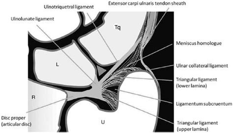 Ulnar Collateral Ligament Wrist Mri