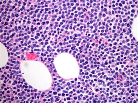 Pathology Outlines Monomorphic Epitheliotropic Intestinal