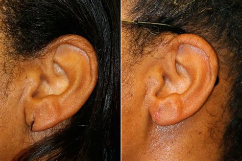 Earlobe Repair in Virginia, Washington D.C. & Maryland