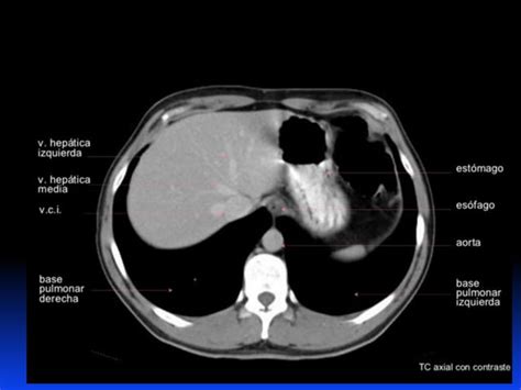 Tac De Abdomen Y Pelvis Pdf