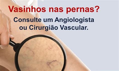 Vasinhos Nas Pernas Angiologia Cl Nica E Cirurgia Vascular