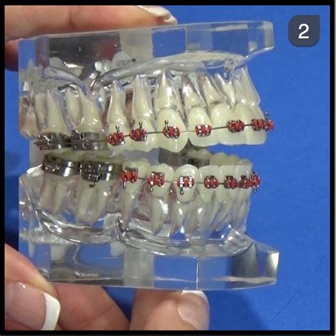 Orthodontic Demonstration Leveling And Aligning Arches With X