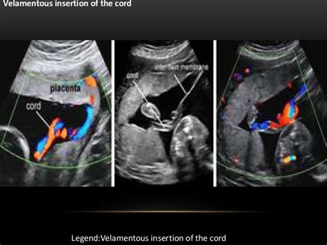 Velamentous Umbilical Cord Ultrasound