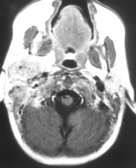 Imaging Of Desmoid Fibromatosis In Pediatric Patients Ajr