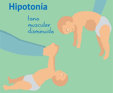 Tipos De Atrofia Muscular Espinal Roche Pacientes