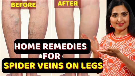 Get Rid Of Varicose Veins Natural Cure For Varicose Veins Get