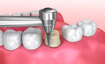 Dental Crown Procedure