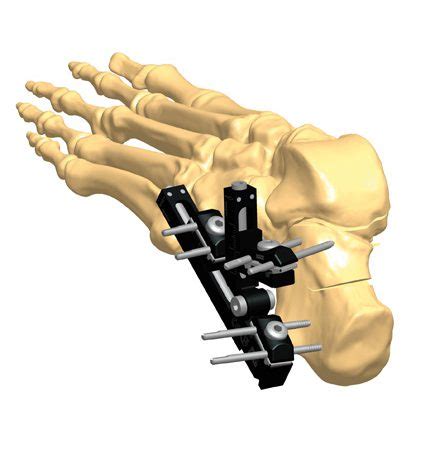 Foot Fracture Treatment Orthofix Abs