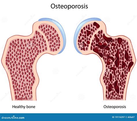 Osteoporosis Stock Vector Illustration Of Compression 19116297