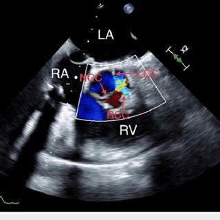 Mid Esophageal TEE Aortic Valve Short Axis View Showing Aortic