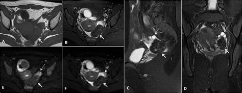 Combination Of Clinical And Mri Features In Diagnosing Ovarian