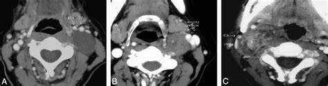 Figure From Imaging Characteristics Of Schwannoma Of The Cervical