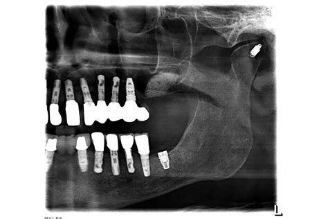 Lateral Sinus Floor Augmentation Using Cerabone Plus Botiss