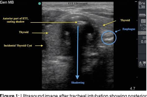 Figure 1 From End Tidal Capnography And Upper Airway Ultrasonography In The Rapid Confirmation