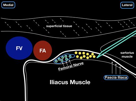 Infrainguinal Fascia Iliaca Plane Block Aka Femoral Nerve Block — Highland Em Ultrasound