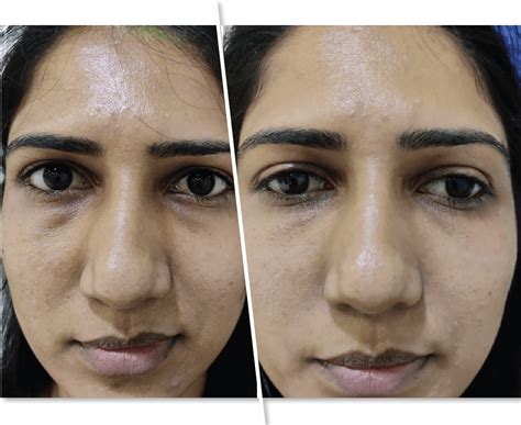 Best Under Eye Dark Circles Removal Treatment At Kolors