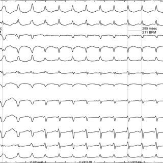 Twelve Lead Electrocardiogram 50 Mm S Spontaneous Changing In The