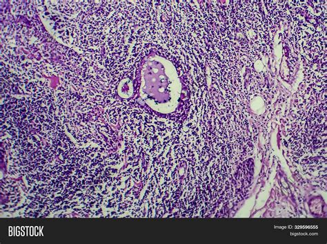 Hodgkins Lymphoma Light Micrograph Photo Under Microscope Image