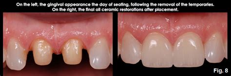 A Comprehensive Guide To Biologic Width - Spear Education