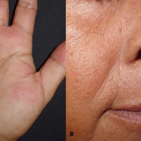 Cutaneous Lesions A Round Keratotic Palmar Pits B Millimetric