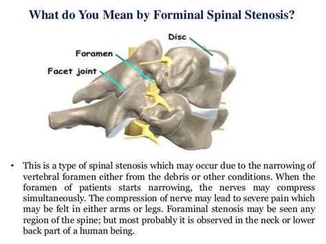 Treatment Of Foraminal Stenosis