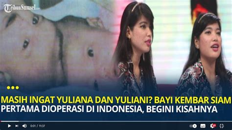 Ingat Yuliana Yuliani Bayi Kembar Siam Pertama Berhasil Dioperasi Di