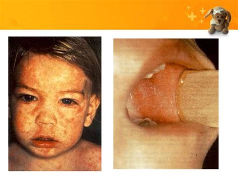 Common Pediatric Skin Rash