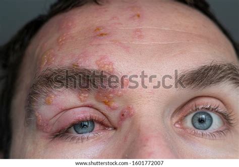 Eyes Man Suffering Herpes Zoster On Stock Photo Edit Now 1601772007