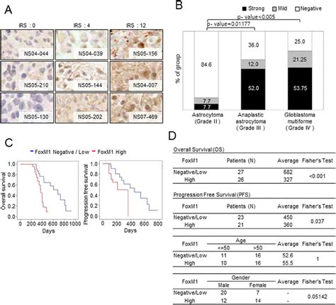 Foxm1 Expression Levels In Clinical Glioma Specimens And Association