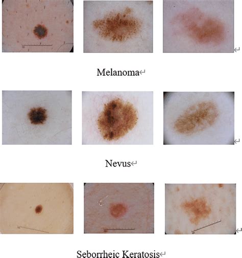 There Are Some Samples Of Melanoma Nevus Seborrheic Keratosis In Free