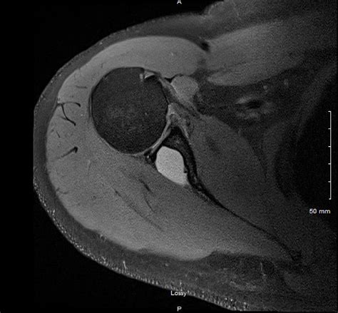 Ganglion Cysts Of The Hand And Wrist