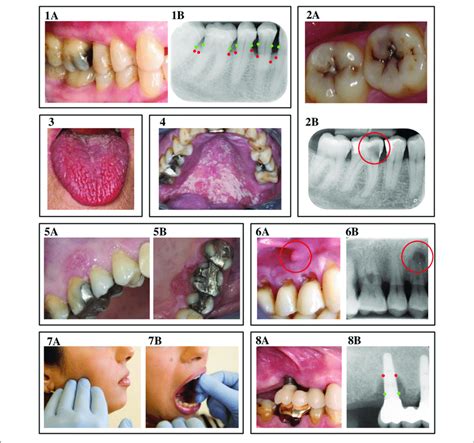 Oral Complications Of Diabetes Mellitus A B Periodontitis A