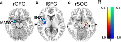 Functional Connectivity Difference Between Euthymic Pbd Patients And