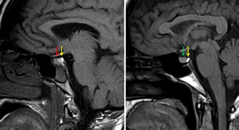 Pituitary Hemorrhage