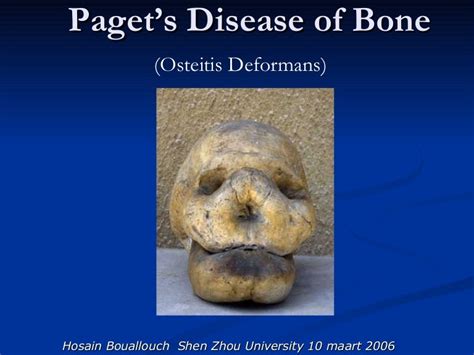 Paget’S Disease Of Bone