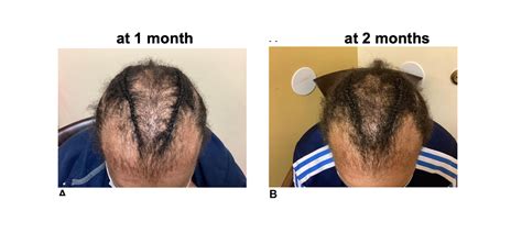 Treatment Of Central Centrifugal Cicatricial Alopecia Ccca With Baricitinib — Donovan Hair Clinic