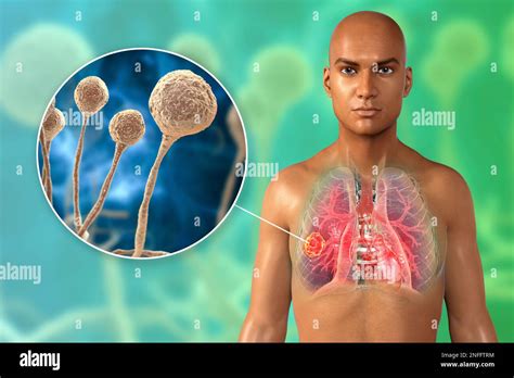 La Mucormicosis Pulmonar O Cigomicosis Una Enfermedad Pulmonar The